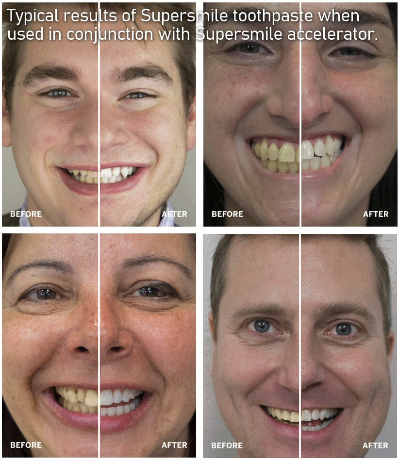 Supersmile Whitening Accelerator System 119g / 102g Supersmile