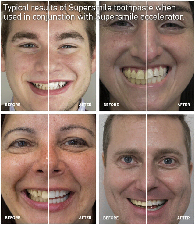 Supersmile Whitening Accelerator 102g Supersmile