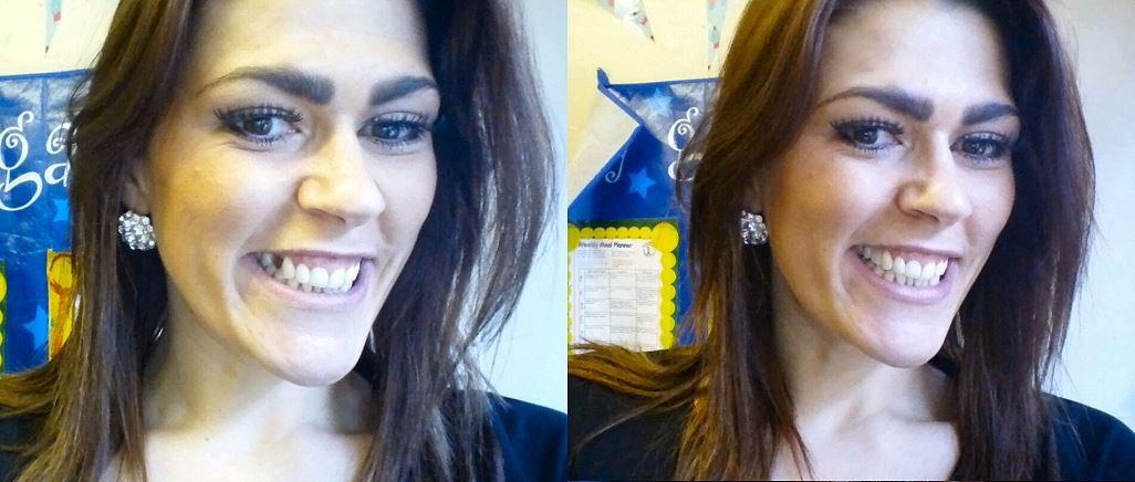 TempTooth Kit (Free Dental Tools) TempTooth