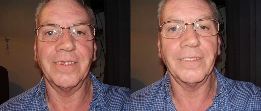 TempTooth Kit (Free Dental Tools) TempTooth