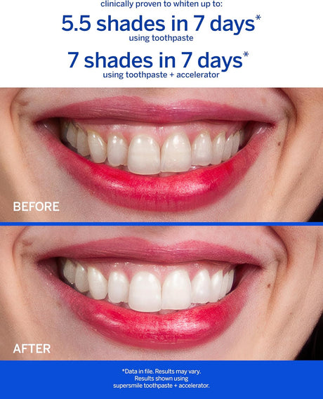 Supersmile Professional Whitening System (Fluoride Free)