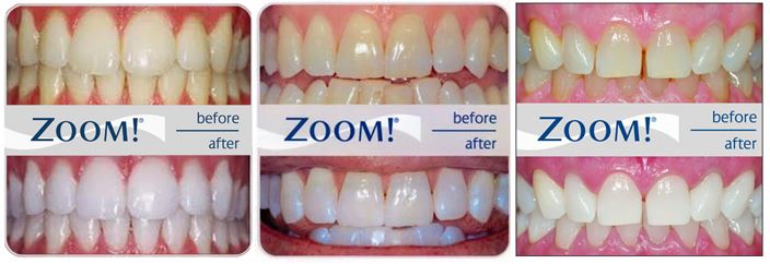 Philips ZOOM! Day White Gel 6% HP + Mouth Trays, Case & Whitening Pen Philips ZOOM 