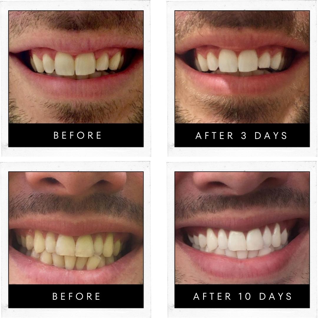 Teeth Whitening Gel 10% CP (Mint) Made In USA (3 Bulk Tubes) - Whiter Smile